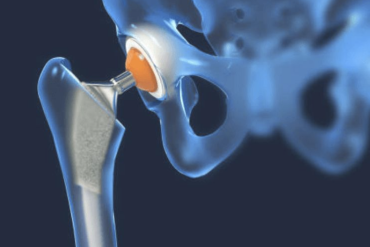 Digitāla ilustrācija, kurā redzama gūžas locītavas protēze ar mākslīgo gūžas implantu, kas ievietots augšstilba kaulā un savienots ar gūžas locītavas ligzdu. Kauli ir puscaurspīdīgi zili, bet implants ir metālisks ar oranžu locītavu.